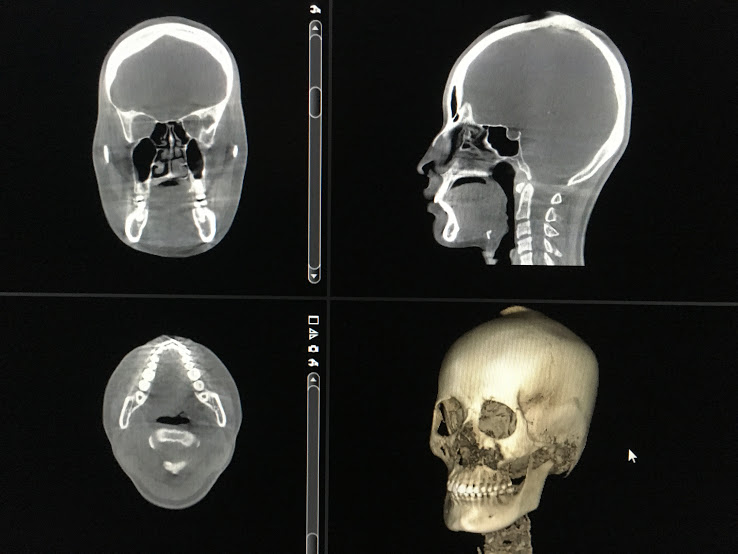 CBCT